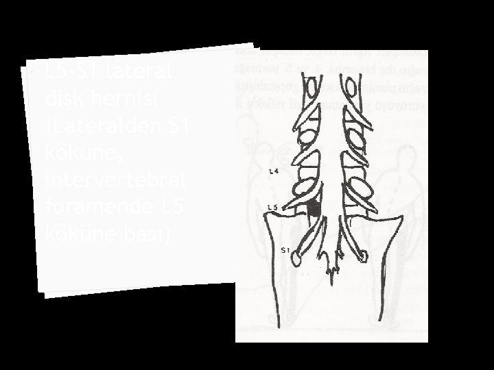  L 5 -S 1 lateral disk hernisi (Lateralden S 1 köküne, intervertebral foramende