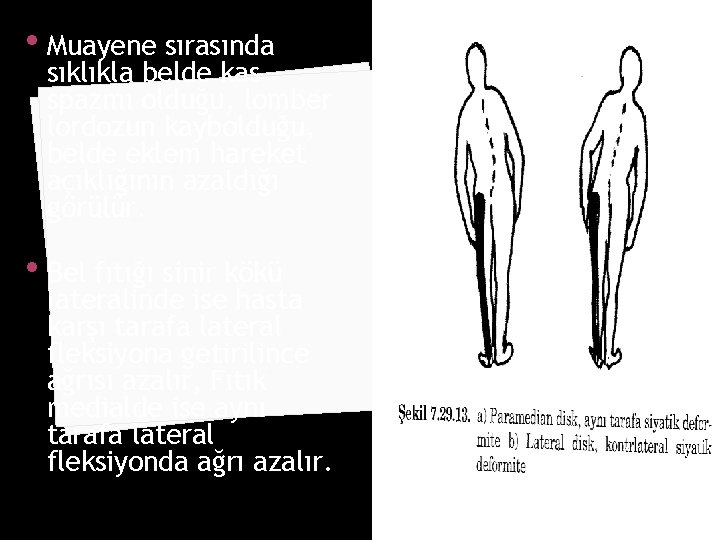  • Muayene sırasında sıklıkla belde kas spazmı olduğu, lomber lordozun kaybolduğu, belde eklem