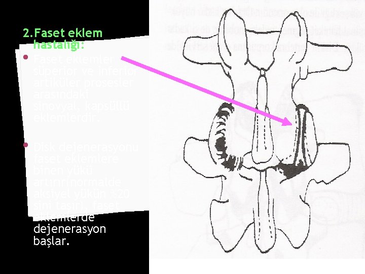 2. Faset eklem hastalığı: • Faset eklemler süperior ve inferior artiküler prosesler arasındaki sinovyal,