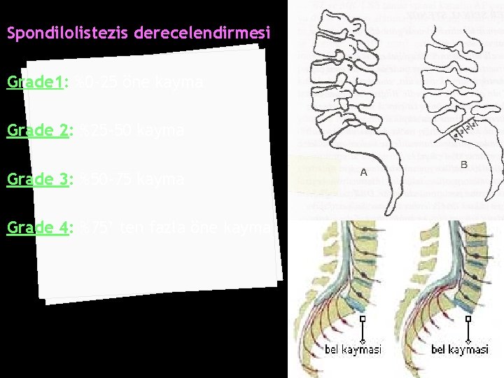 Spondilolistezis derecelendirmesi Grade 1: %0 -25 öne kayma Grade 2: %25 -50 kayma Grade