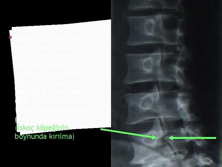  • Spondiloliziste lezyon yeteri kadar büyük ise genellikle lezyonu lokalize etmek için herhangi