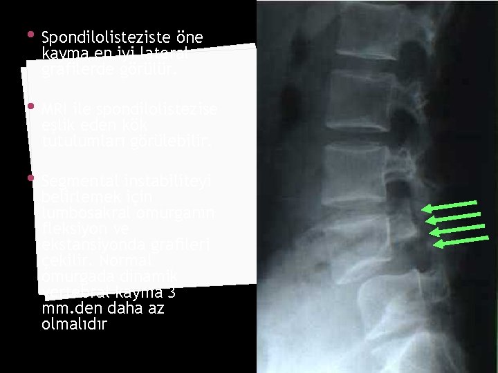  • Spondilolisteziste öne kayma en iyi lateral grafilerde görülür. • MRI ile spondilolistezise