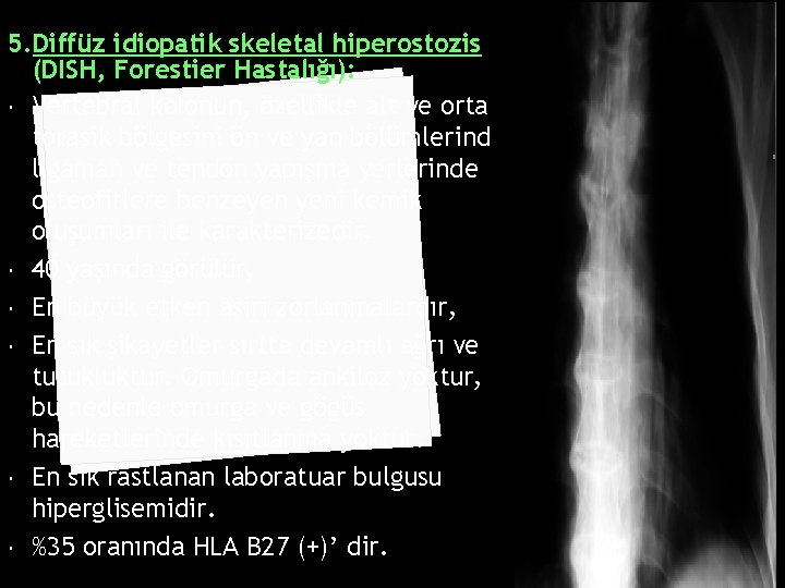 5. Diffüz idiopatik skeletal hiperostozis (DISH, Forestier Hastalığı): Vertebral kolonun, özellikle alt ve orta