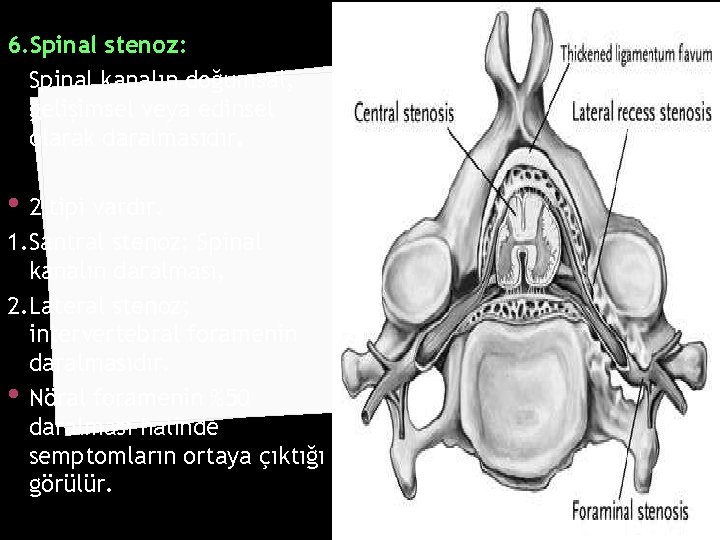 6. Spinal stenoz: Spinal kanalın doğumsal, gelişimsel veya edinsel olarak daralmasıdır. • 2 tipi