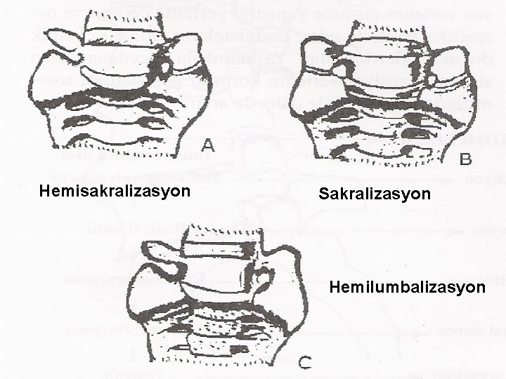 Hemisakralizasyon Sakralizasyon Hemilumbalizasyon 