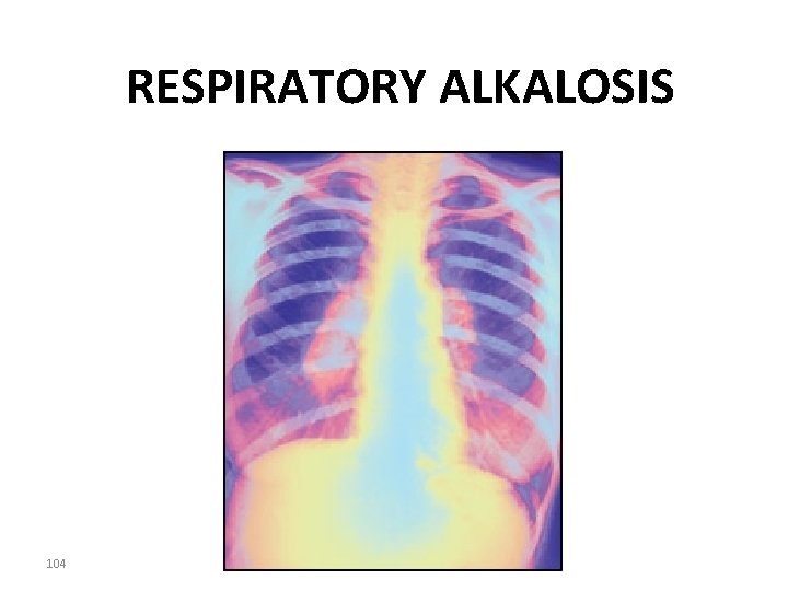 RESPIRATORY ALKALOSIS 104 