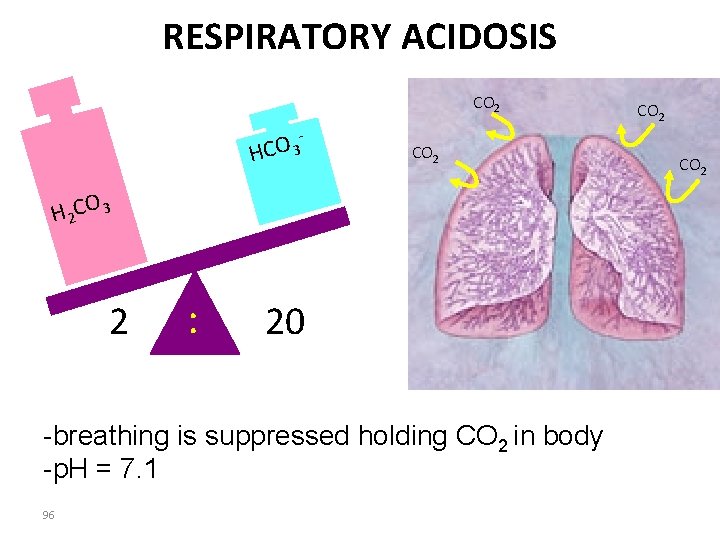 RESPIRATORY ACIDOSIS CO 2 - HCO 3 CO 2 H 2 CO 3 2