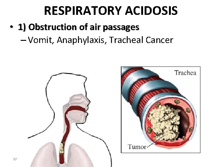 RESPIRATORY ACIDOSIS • 1) Obstruction of air passages – Vomit, Anaphylaxis, Tracheal Cancer 97