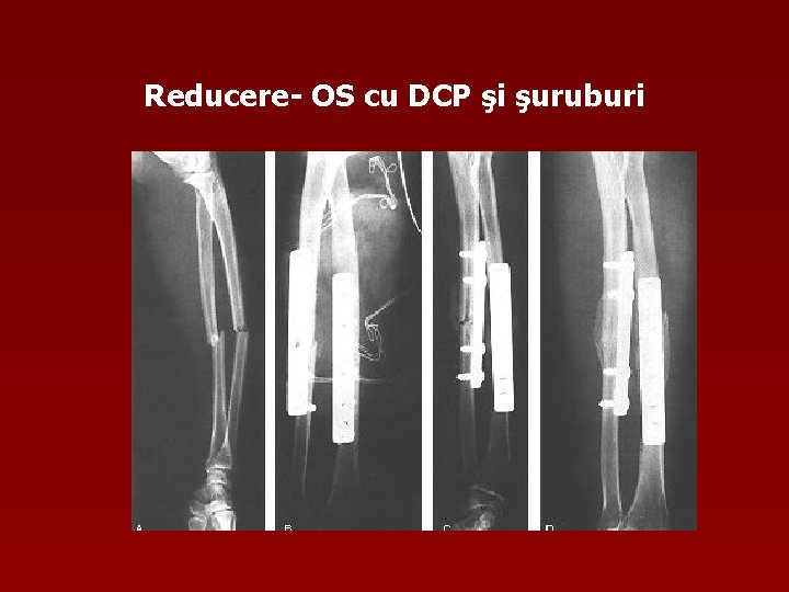 Reducere- OS cu DCP şi şuruburi 