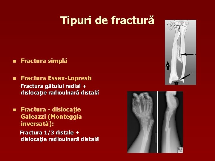 Tipuri de fractură n Fractura simplă n Fractura Essex-Lopresti Fractura gâtului radial + dislocaţie