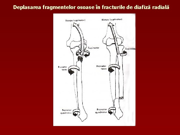 Deplasarea fragmentelor osoase în fracturile de diafiză radială 