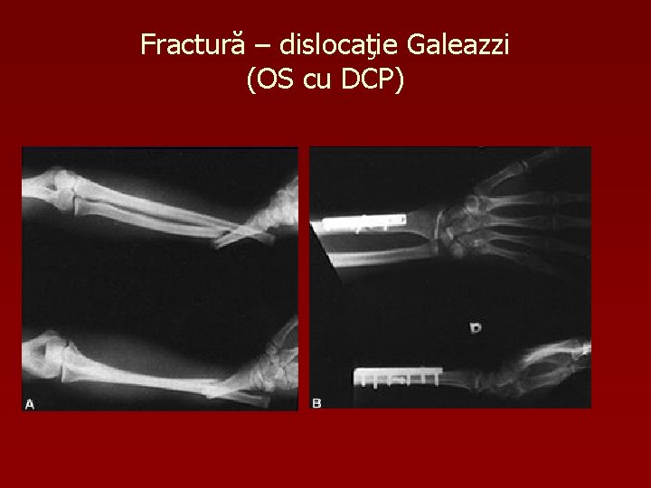 Fractură – dislocaţie Galeazzi (OS cu DCP) 