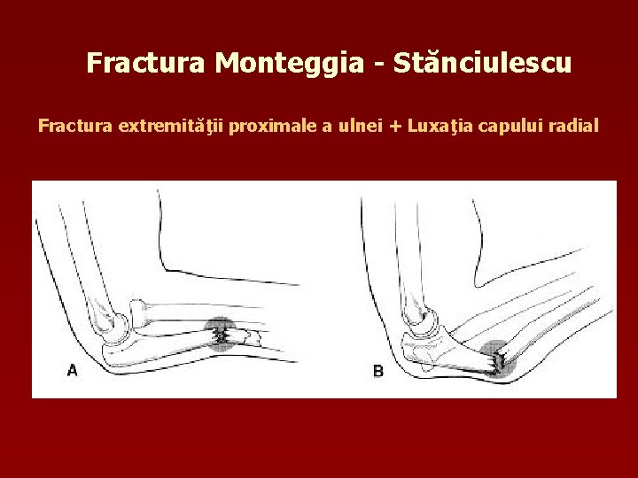 Fractura Monteggia - Stănciulescu Fractura extremităţii proximale a ulnei + Luxaţia capului radial 