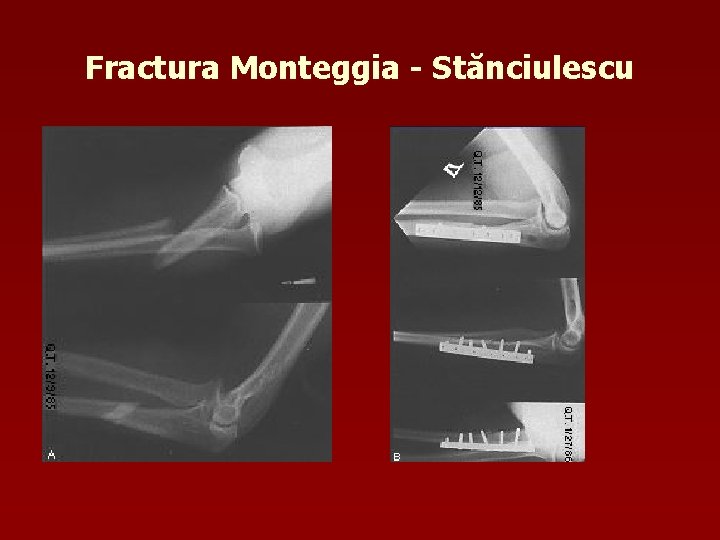 Fractura Monteggia - Stănciulescu 