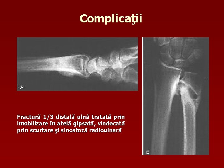 Complicaţii Fractură 1/3 distală ulnă tratată prin imobilizare în atelă gipsată, vindecată prin scurtare