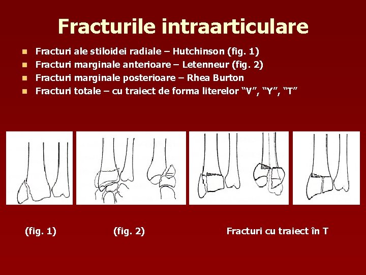 Fracturile intraarticulare Fracturi ale stiloidei radiale – Hutchinson (fig. 1) n Fracturi marginale anterioare