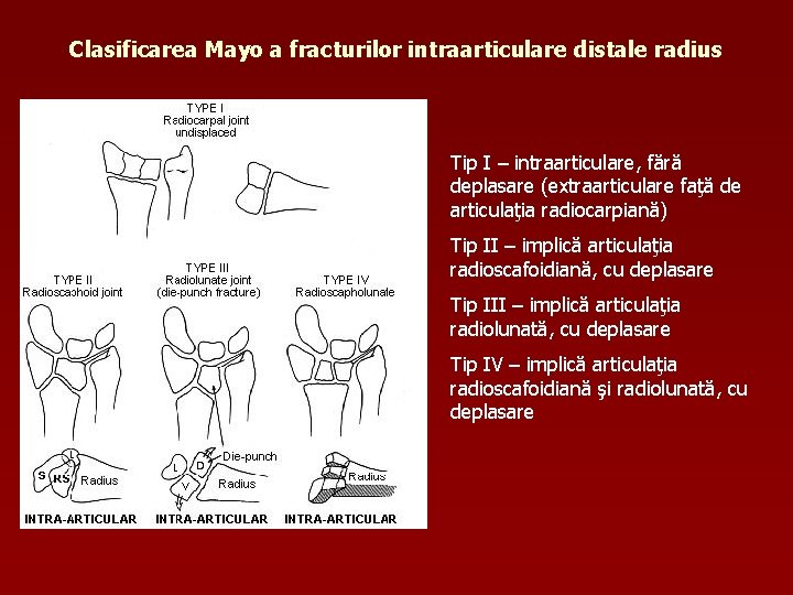 Clasificarea Mayo a fracturilor intraarticulare distale radius Tip I – intraarticulare, fără deplasare (extraarticulare