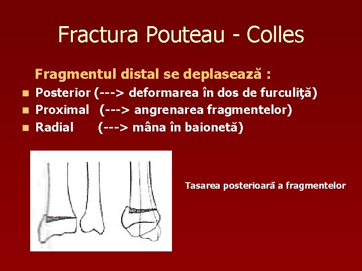 Fractura Pouteau - Colles Fragmentul distal se deplasează : Posterior (---> deformarea în dos