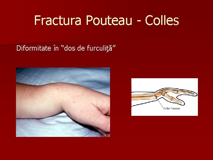 Fractura Pouteau - Colles Diformitate în “dos de furculiţă” 