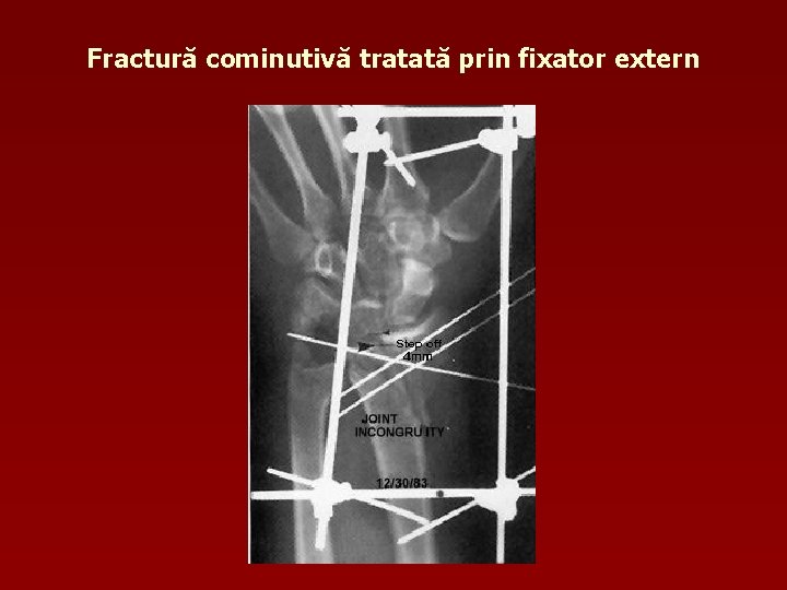 Fractură cominutivă tratată prin fixator extern 