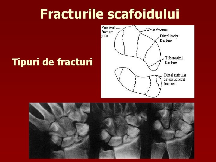 Fracturile scafoidului Tipuri de fracturi 