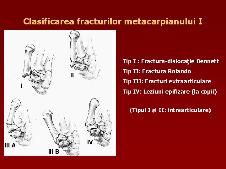 Clasificarea fracturilor metacarpianului I Tip I : Fractura-dislocaţie Bennett Tip II: Fractura Rolando Tip