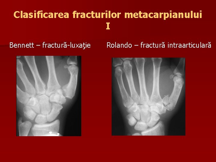 Clasificarea fracturilor metacarpianului I Bennett – fractură-luxaţie Rolando – fractură intraarticulară 