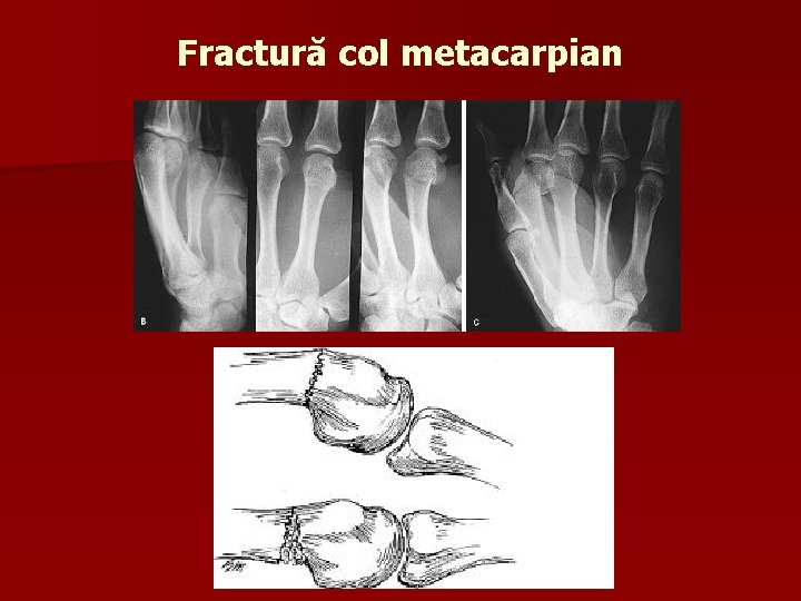 Fractură col metacarpian 