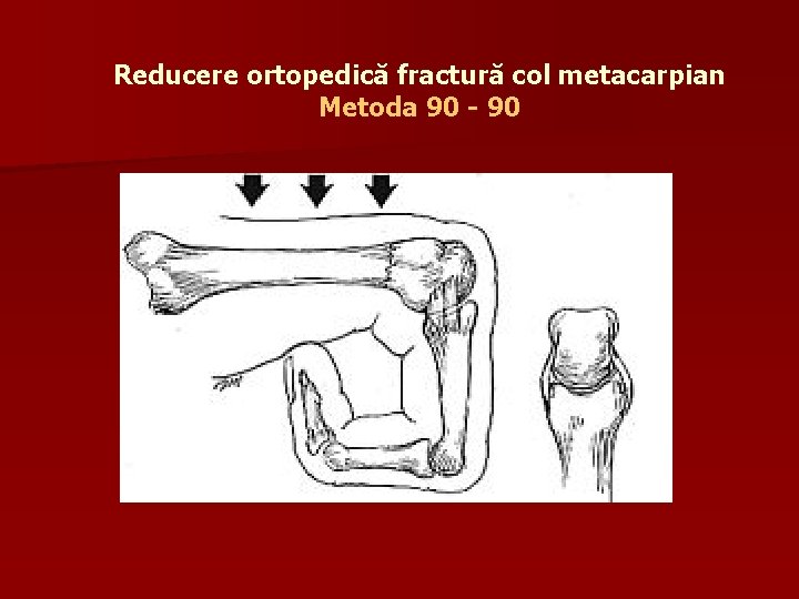 Reducere ortopedică fractură col metacarpian Metoda 90 - 90 