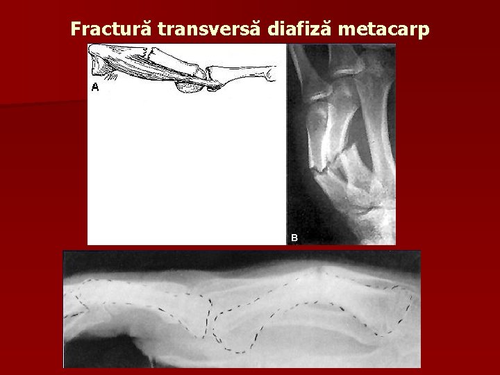 Fractură transversă diafiză metacarp 