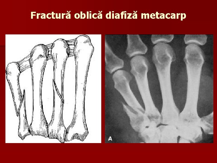 Fractură oblică diafiză metacarp 