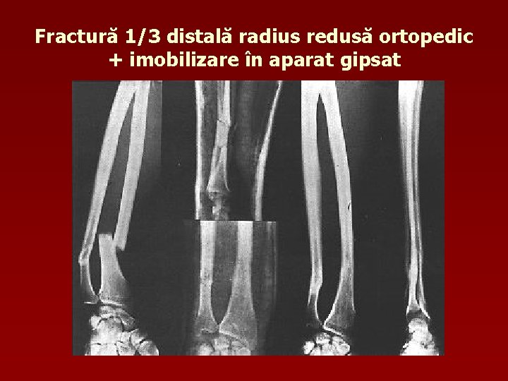Fractură 1/3 distală radius redusă ortopedic + imobilizare în aparat gipsat 