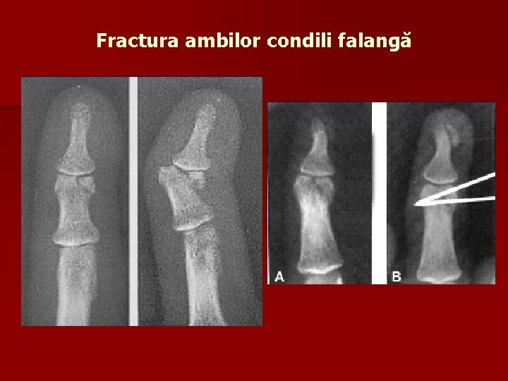 Fractura ambilor condili falangă 