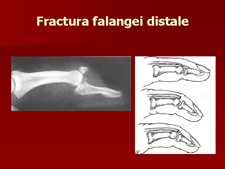 Fractura falangei distale 