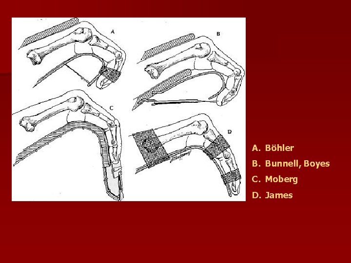 A. Böhler B. Bunnell, Boyes C. Moberg D. James 