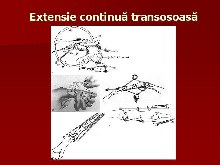 Extensie continuă transosoasă 