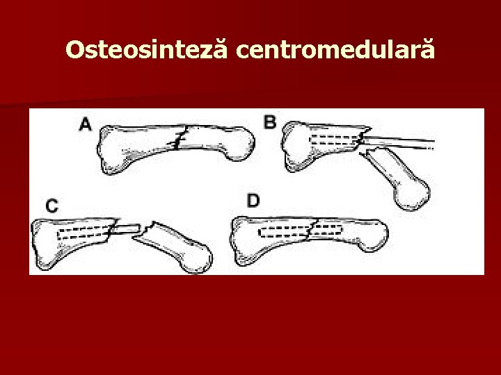 Osteosinteză centromedulară 