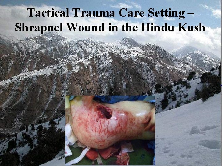 Tactical Trauma Care Setting – Berator Shrapnel Wound in the Hindu Kush 