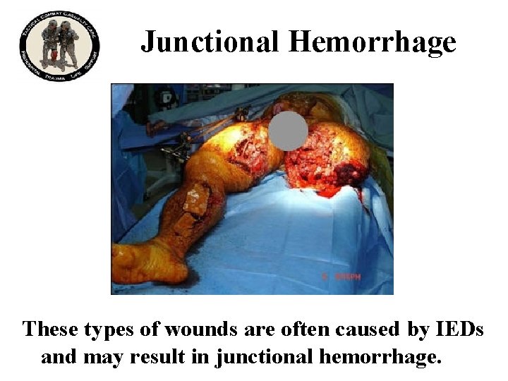 Junctional Hemorrhage These types of wounds are often caused by IEDs and may result