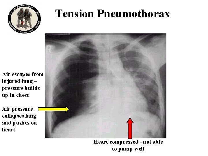 Tension Pneumothorax Air escapes from injured lung – pressure builds up in chest Air
