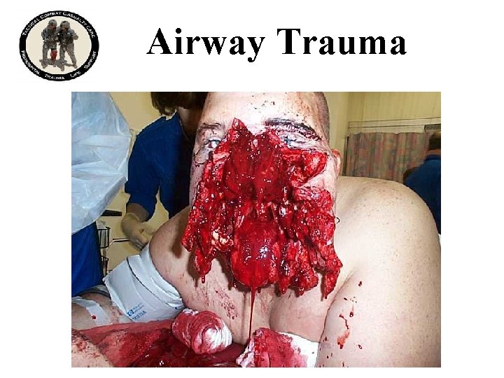 Airway Trauma 