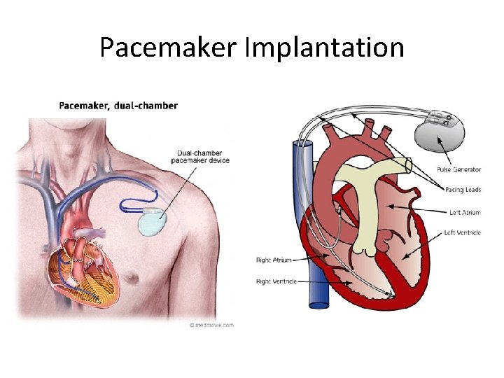 Pacemaker Implantation 