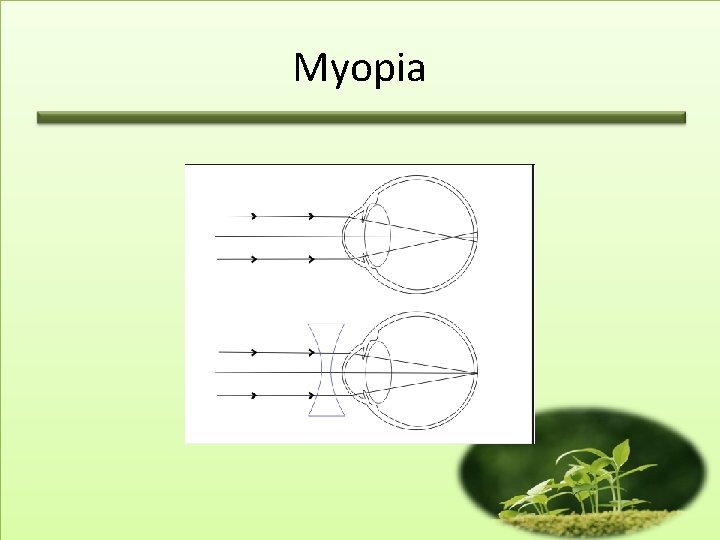 Myopia 