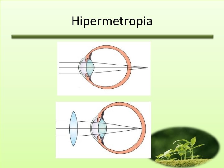 Hipermetropia 