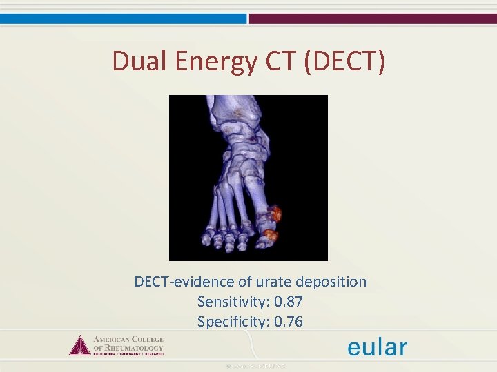 Dual Energy CT (DECT) DECT-evidence of urate deposition Sensitivity: 0. 87 Specificity: 0. 76