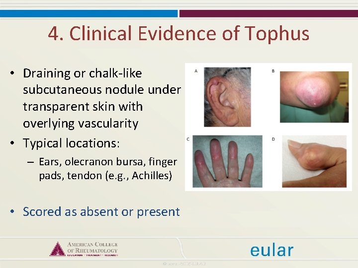 4. Clinical Evidence of Tophus • Draining or chalk-like subcutaneous nodule under transparent skin