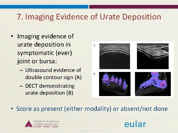 7. Imaging Evidence of Urate Deposition • Imaging evidence of urate deposition in symptomatic