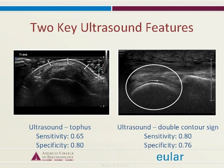 Two Key Ultrasound Features Ultrasound – tophus Sensitivity: 0. 65 Specificity: 0. 80 Ultrasound