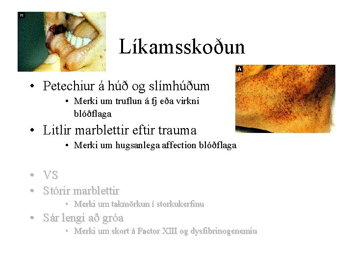 Líkamsskoðun • Petechiur á húð og slímhúðum • Merki um truflun á fj eða
