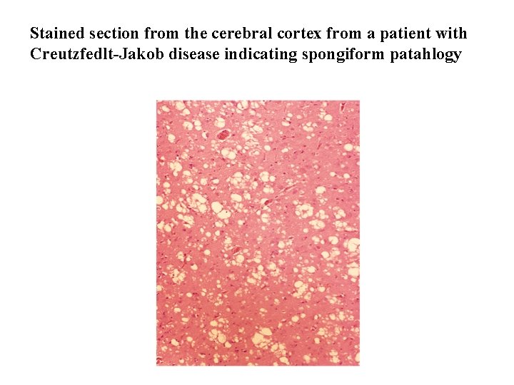 Stained section from the cerebral cortex from a patient with Creutzfedlt-Jakob disease indicating spongiform